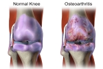 A Comprehensive Guide to Knee Osteoarthritis