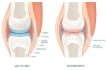 How Genetics May Influence Your Risk for Osteoarthritis