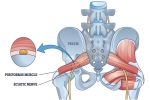 Understanding Piriformis Syndrome and Its Management Through Interventional Pain Techniques