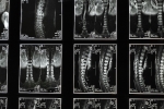 Understanding Scoliosis and Its Management