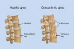 Understanding Spinal Arthritis and How Interventional Pain Management Can Help