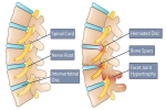 Understanding Spinal Stenosis: A Comprehensive Overview