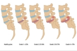 Understanding Spondylolisthesis and its Treatment with Interventional Pain Management