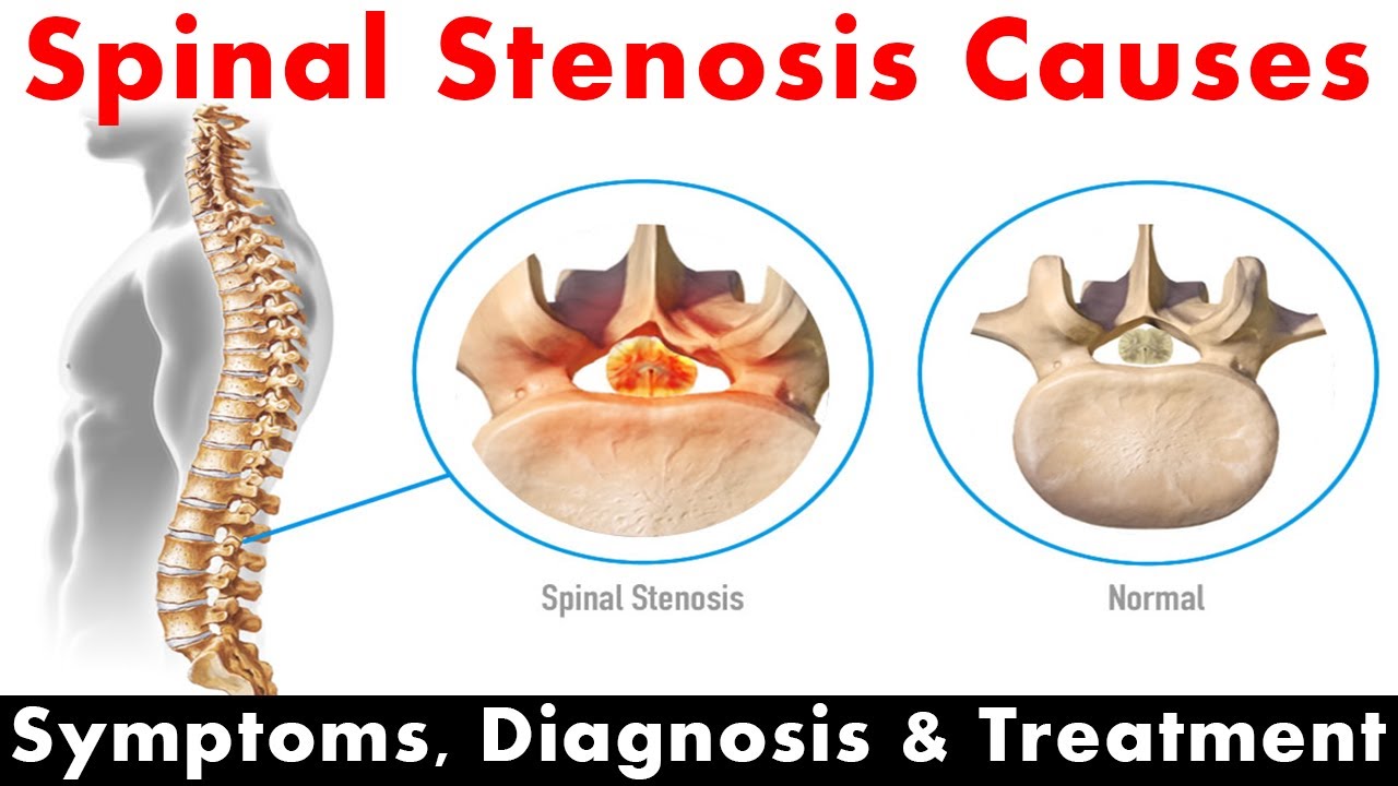 Spinal Stenosis Causes, Diagnosis & Management