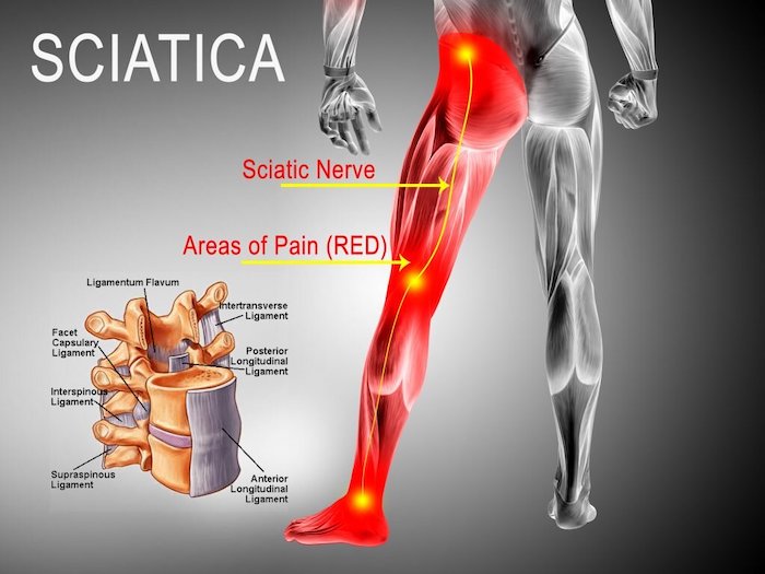 4 Simple Stretches for Sciatica Pain Relief
